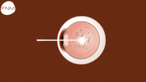 Vitreolysis feature